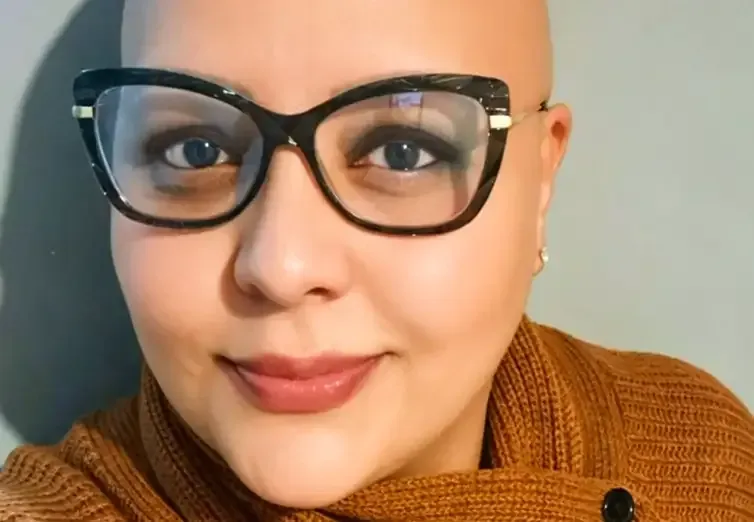 Brasília - DF - A alopecia areata é uma doença autoimune, caracterizada pelo ataque ao folículo piloso. ( Juliana Fernandes convive com a alopecia areata universal há mais de 20 anos). Foto: arquivo pessoal