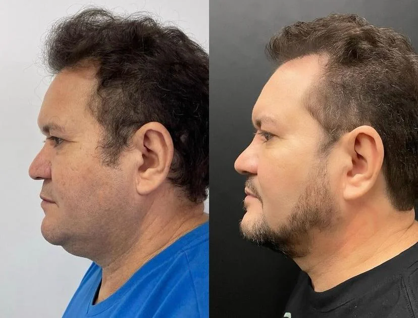 Veja o antes e depois de Ximbinha Reprodução/Instagram