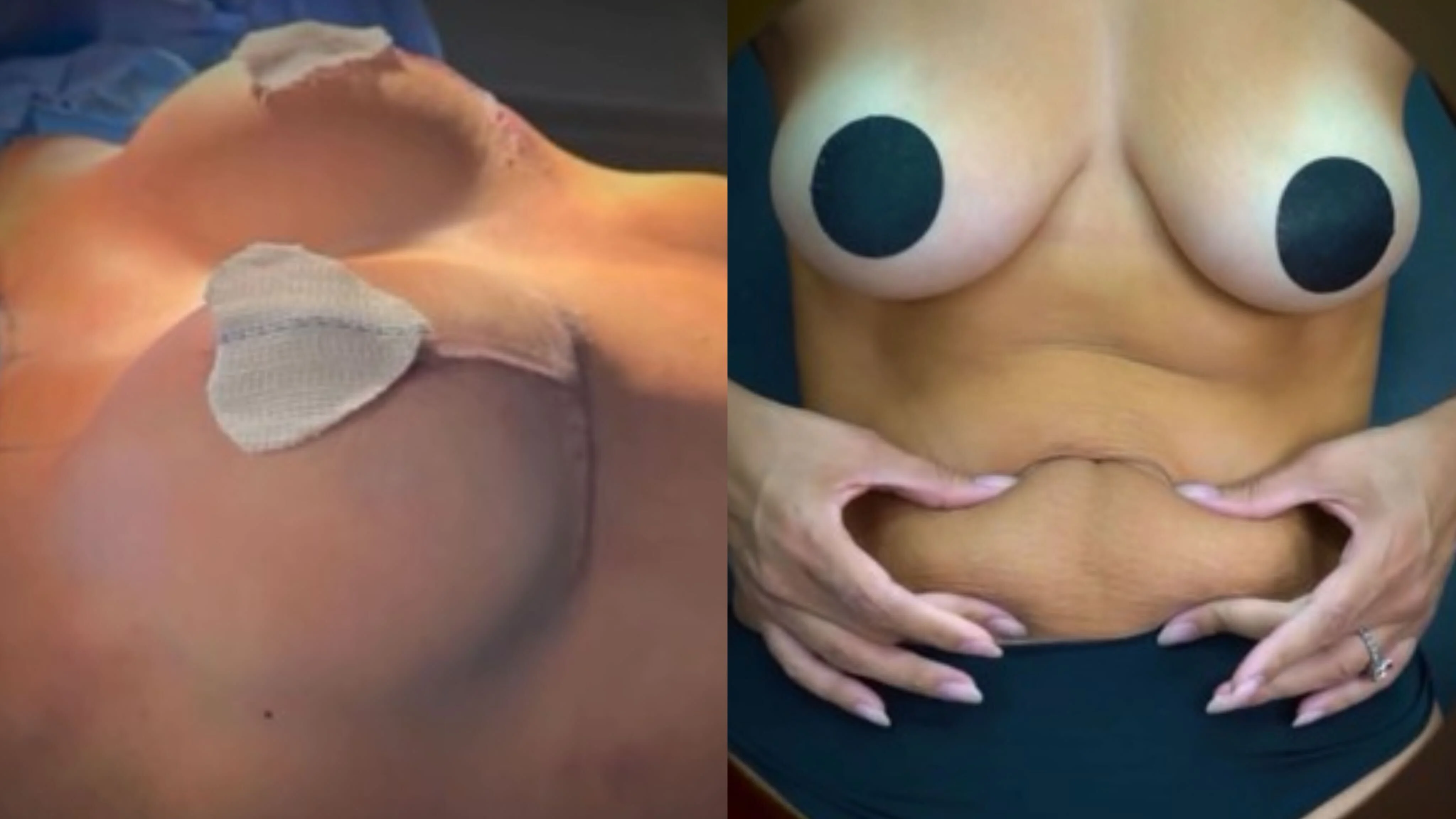 Deniziane também fez intervenção estética na região dos seios Reprodução Instagram - 11.6.2024