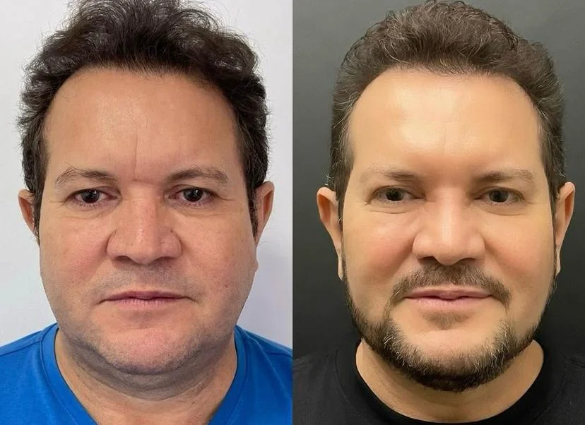 Veja o antes e depois de Ximbinha Reprodução/Instagram