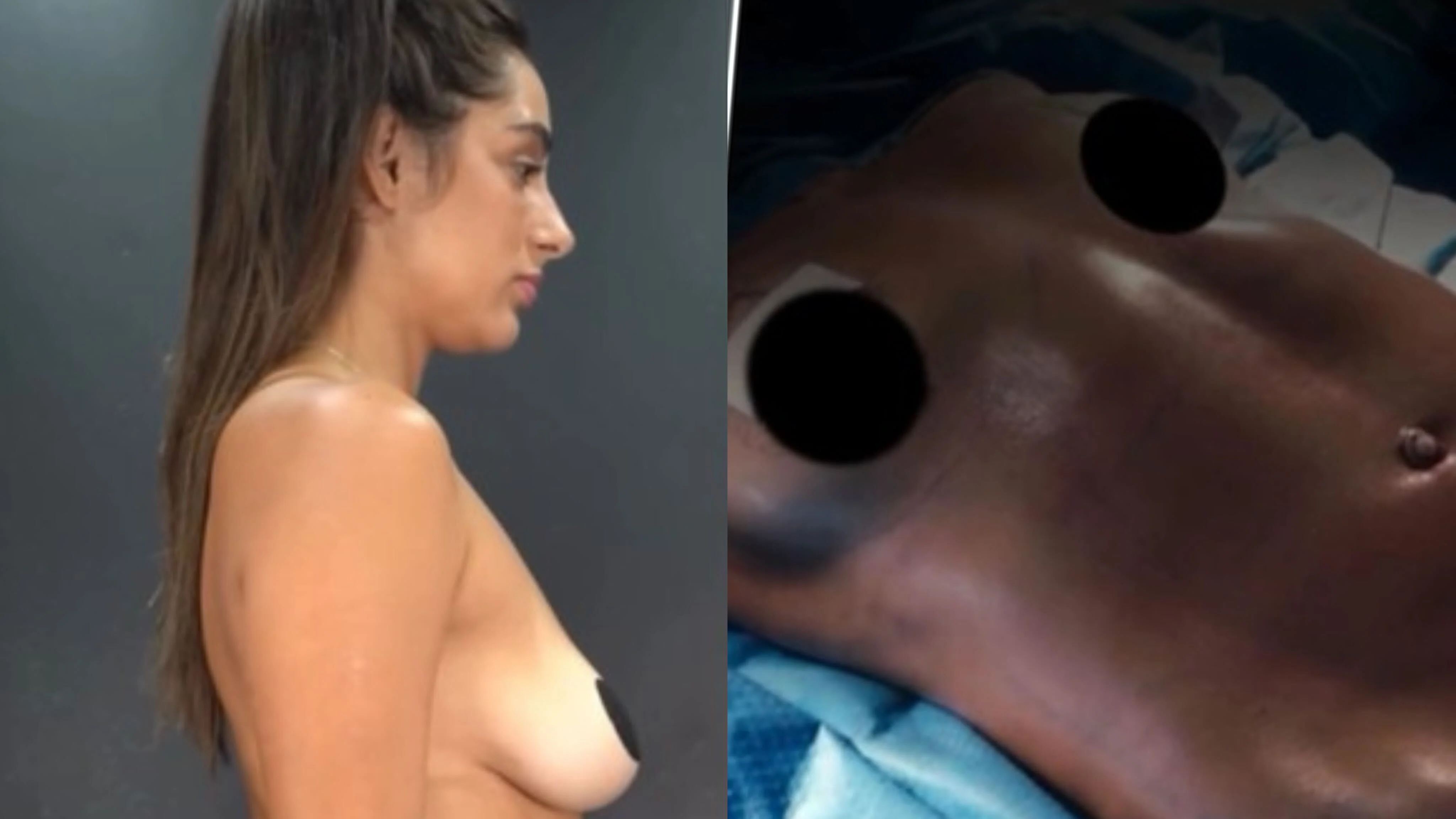 Deniziane passou por lipoaspiração Reprodução Instagram - 11.6.2024
