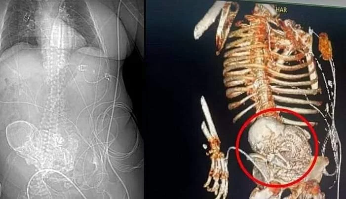 Feto calcificado estava alojado fora do útero de mulher Feto calcificado foi implantado fora do útero