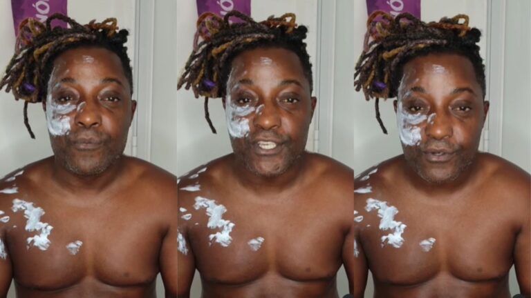 Thyago, do Ilhados com a Sogra, tem queimaduras no rosto após acidente