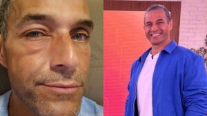 Fabricio Battaglini faz alerta aos fãs após inflamação no olho