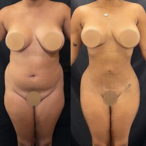 Thalyta Alves mostrou o antes e depois de sua lipoaspiração Reprodução/Instagram