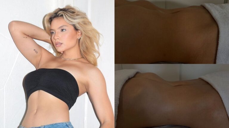 Gabriely Miranda posta antes e depois de procedimento na barriga; foto
