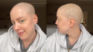 Em tratamento contra leucemia, Fabiana Justus comemora cabelo nascendo