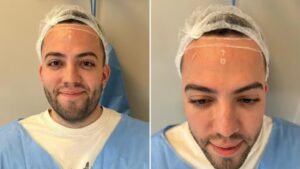 Lucas Rangel  realiza cirurgia para diminuir o tamanho testa