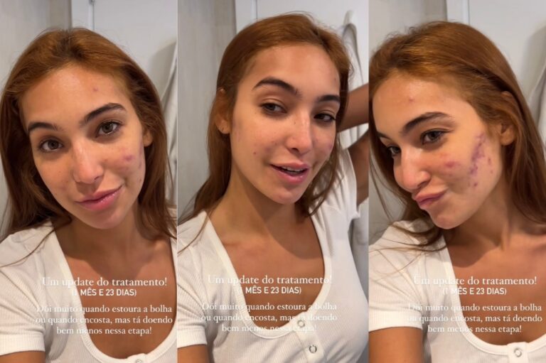 Vanessa Lopes mostra pele sem maquiagem durante tratamento de acne