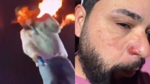 Após ser atingido por chamas, sertanejo Léo mostra queimaduras