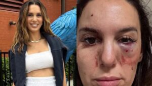 Ex-estrela da Disney detalha momento em que levou tiros no rosto