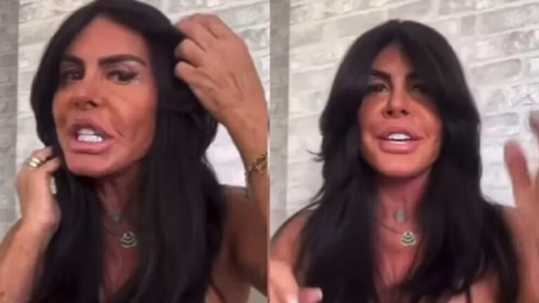 Gretchen mostra nova harmonização facial e exibe rosto sem filtro