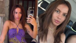 Anitta anuncia transição capilar após intervenções no rosto