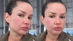 "Igual um baiacu": Juliette incha após tratamento inusitado