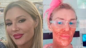 Ex-modelo se queima ao tentar matar parasita no rosto: "Derreter"