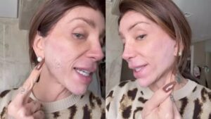 Maya Massafera exibe pele irritada após laser fracionado
