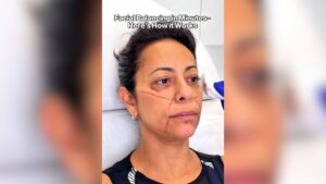 Antes e depois de Samantha após consulta com médico da Kardashian