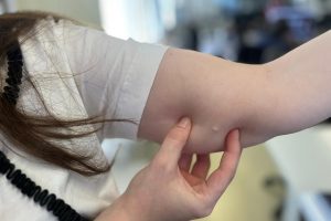 Com expansão de LARCs, MS registra a menor taxa de gravidez na adolescência em uma década