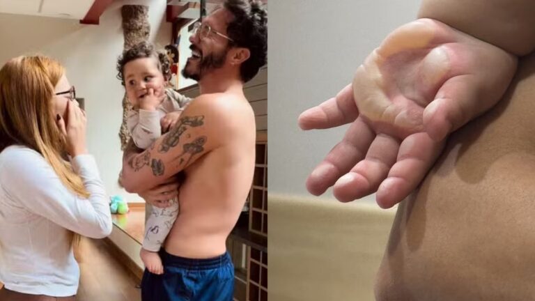 Filho de Viih Tube e Eli sofre queimadura e passa por cirurgia