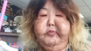 Médico detalha cirurgia de Juju do Pix; veja antes e depois